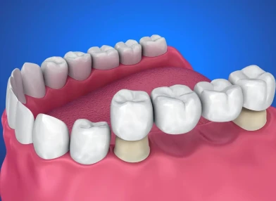 4-unit dental bridge package for multiple tooth replacement.