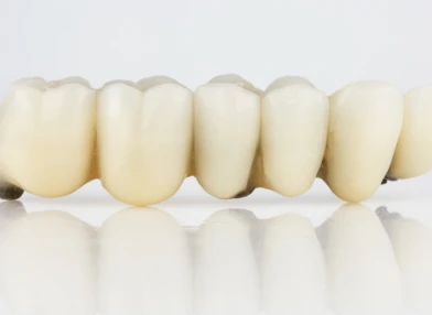 5-unit dental bridge package for extensive tooth restoration.