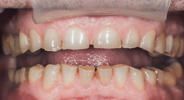 Dental cleaning performed by professional dentists in San Diego.