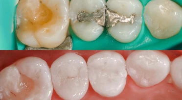 Amalgam filling removal replaced with mercury-free Inlays and Onlays.