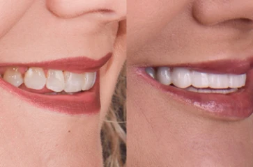 Post-treatment smile with noticeable dental improvement.
