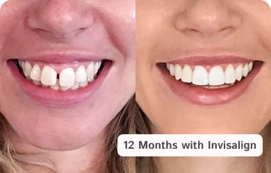 Before and after comparison of Invisalign treatment at My Smile dental clinic in San Diego
