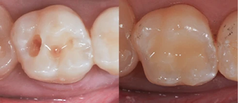 Before and after images of a tooth treated with root canal therapy to eliminate infection.