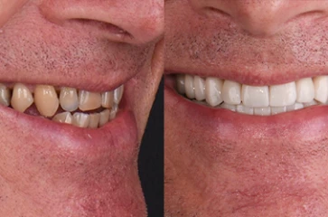 Close-up of a patient’s teeth before cosmetic dental treatment.