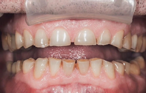 Bruxism blog article image addressing teeth grinding and treatments provided in San Diego.
