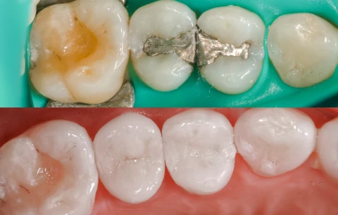 Amalgam fillings educational image discussing cavity treatment options available at My Smile Clinic in San Diego.