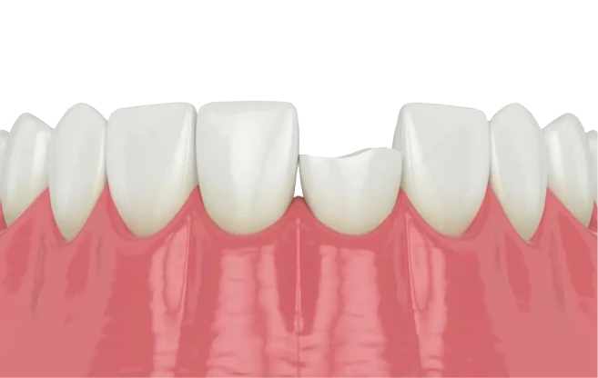 Broken tooth close-up showing damage before treatment; emergency dental repair and restorative dentistry in San Diego.