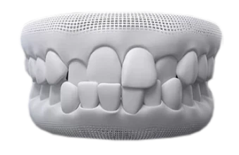 3D dental model showing gap teeth that can be treated with clear aligner orthodontics.