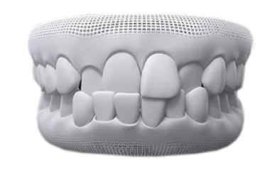 Illustration of crossbite dental condition, treatable with Invisalign aligners.
