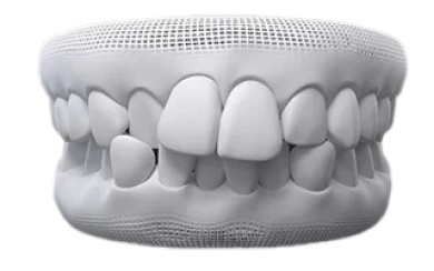 Example of crowded teeth before Invisalign clear aligner treatment.