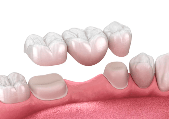 Types Of Dental Bridges