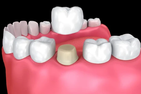 Image showcasing dental crown in San Diego available at My Smile Dental Clinic with expert dentists.