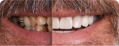 Before and after images of a patient showcasing the results of dental crown treatment.