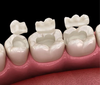 Dental Inlays and Onlays composite filling image, demonstrating cavity repair and tooth restoration in San Diego, California.