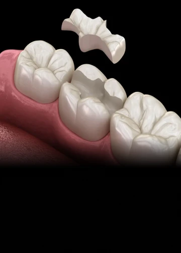 Dental inlay restoration used to repair damaged teeth with affordable pricing options.