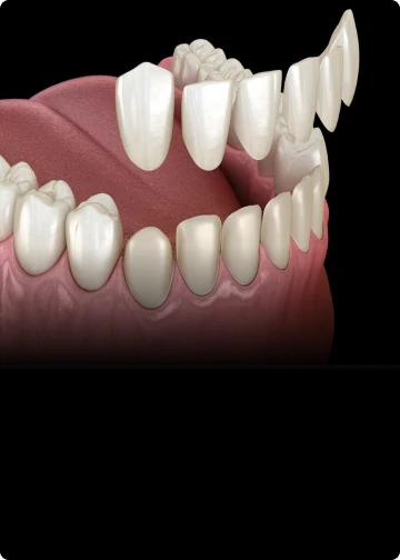 Cosmetic dental veneers improving tooth shape and color with transparent pricing