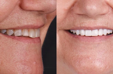 Mid-treatment view showing progress in a smile transformation.