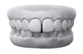 3D dental model showing gap teeth that can be treated with clear aligner orthodontics.