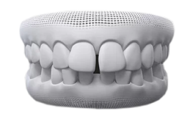 Visual showing a gap between teeth, a condition Invisalign can effectively fix