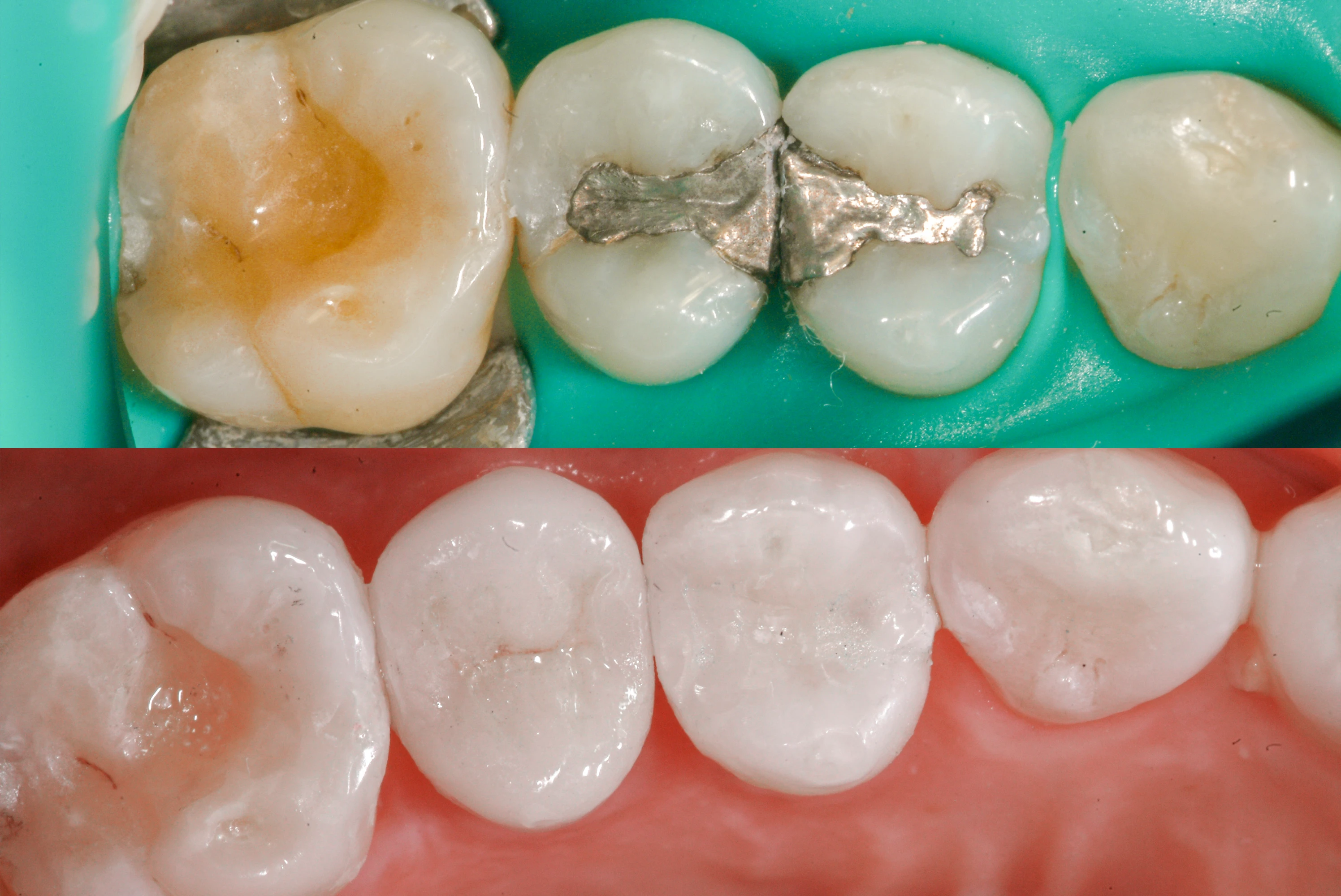 can you take glutathione if you have amalgam fillings Dangers of Dental | Total Care Dental Safe Mercury Amalgam Fillings Removal