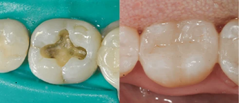Before and after images of a tooth treated with root canal therapy to eliminate infection.