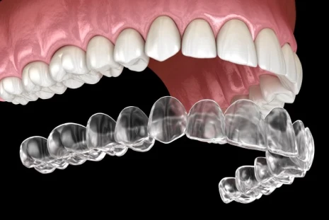 Invisalign clear aligners for orthodontic correction available at My Smile Clinic in San Diego.