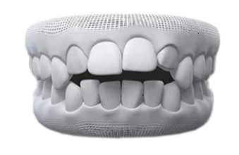 Patient with open bite wearing Invisalign braces.