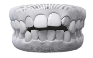 Visual of an open bite, a condition corrected by Invisalign clear aligners.