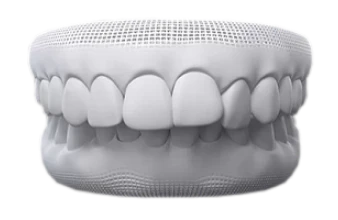 3D dental model displaying an over bite misalignment treated with clear aligners.