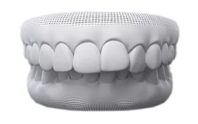 Diagram of an overbite issue treatable with Invisalign aligners.