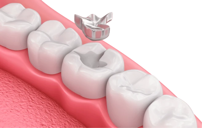 Dental diagram showcasing Amalgam filling removal from cavity to replac it with mercury-free Inlays and Onlays options.