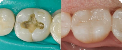 Before and after photos of a root canal patient highlighting restored teeth and a brighter smile.