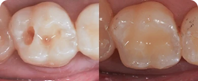 Visible transformation in dental health shown through before and after images from a satisfied root canal patient.