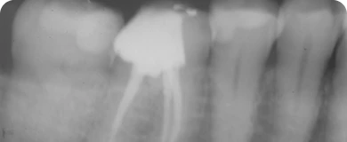 Dental X-ray image illustrating successful root canal treatment and healthy restored roots.