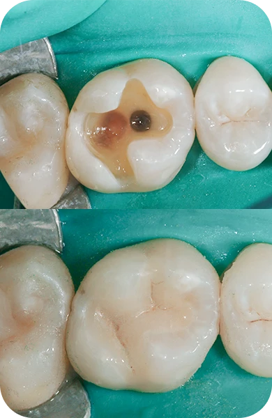 Side-by-side comparison of a patient’s teeth before and after root canal therapy in San Diego.