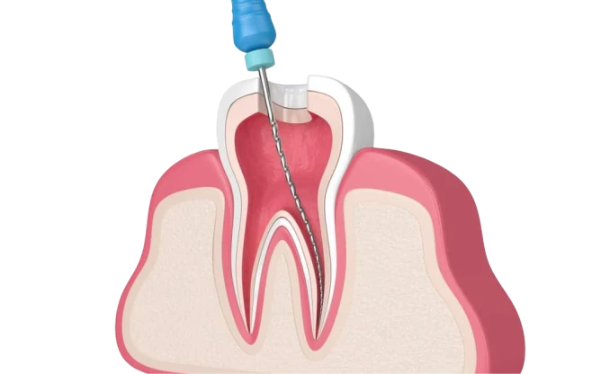 Dental diagram of root canal structure and oral health analysis at My Smile Clinic in San Diego.