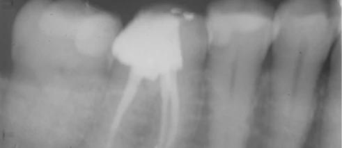 Before and after images of a tooth treated with root canal therapy to eliminate infection.