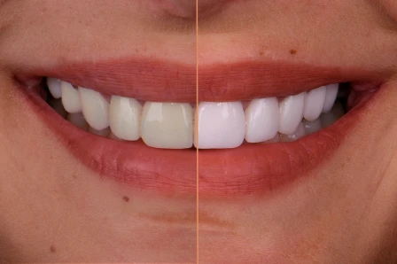 Teeth whitening comparison at My Smile Clinic in San Diego, showcasing several shades of visible lightening.
