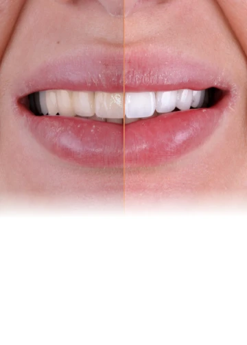 Bright white smile after professional teeth whitening treatment at an affordable cost.