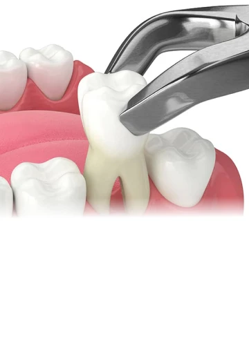 Dental illustration showing a routine tooth extraction procedure with clear pricing.