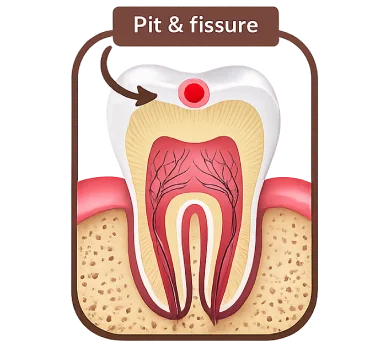 Diagram showing pit and fissure cavity on a tooth for illustrative purposes