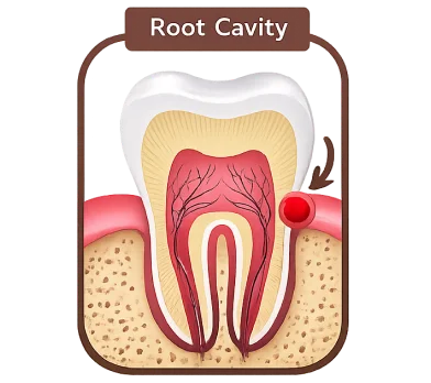Diagram showing root cavity affecting a tooth for illustrative purposes