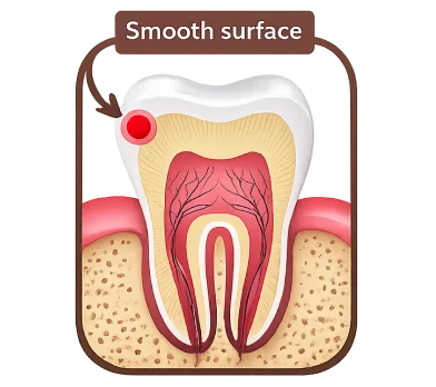 Diagram showing smooth surface cavity on a tooth  for illustrative purposes