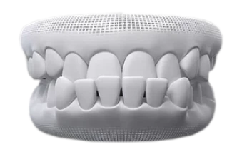 3D dental model showing an under bite that can be improved with clear aligners.