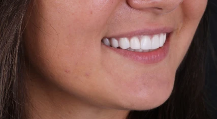 Bright white smile close-up captured at My Smile, showcasing the benefits of professional cosmetic care and expert dental treatments in San Diego.